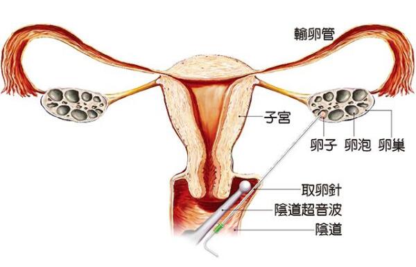 厦门无痛人流